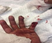 Father in law got his hand caught in a king crab pot reel. The rope lacerated his fingers and his pinky got caught in the pulley. 40 minute boat ride back into port, and surgery followed to remove the bits of shattered bones in his pinkey. He is in good s from father in law fuck his son wife