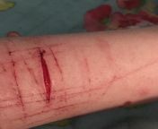 Should I see a doctor? Its not super big or deep but its been a few hours and its still bleeding a bit and not closing up from kannada actor deep sannidhi nude s