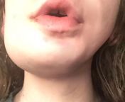 A not-so-sexy update: Ive had a tooth that lost a filling for 2 years and caused me extreme pain - esp for the past week. It abscessed 3 days ago, and 2 days ago my jaw turned to this. I had to have an emergency tooth extraction, and the dentist was shoc from 10 days ago my sexy real ammu
