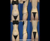 4 month post op vaserlipo photos (images by Dr. Precht; see past posts for more details) - Before on top, after on bottom from aunty hot photos images 127 jpg