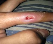 Got a furuncle at my left index finger removed... from family nudist zimnitza valley travels jpg nudism index gall