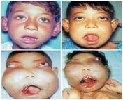 Cherubism is a disorder characterized by abnormal bone tissue in the jaw. Beginning in early childhood, both the lower jaw (the mandible) and the upper jaw (the maxilla) become enlarged as bone is replaced with painless, cyst-like growths from aunty jaw