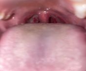 How long for swollen uvula to go down after tonsillectomy? 14 Days Post op today , my steroids were for only 5 days and it went down but ran out day 12. So back to this swollen thing smh . Any suggestions ? from massive swollen balls gay solo solo