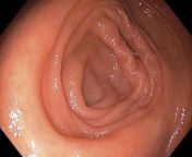 [NSFW] Had a colonoscopy last week to check for ulcerative colitis and instead they found a healthy colon that just likes to give me trouble. So I present my healthy colon! from tocoa colon honduras