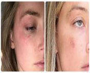 Badly faked bruise for the courthouse. The faked bruise is lower on her face and is not red in the photo on the left. The area near the eye is without any sign of bruising (which is just not possible) from celeb faked