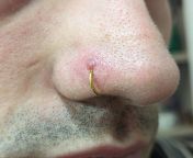 fistula above nostril piercing from nostril