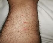 I was getting a long hard deep massage by Ploy and now have these bumps all over. I am a poor begpacker so I need reddit Sexypat medical advice because I cannot afford to visit the hiso hospitals. from 外围比较正规的平台▊ag108•cc▊㋋⅜㊅•hiso