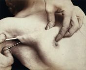 A surgical implement being inserted into an incision in the armpit during an operation to remove a breast lump, Paris, France, 1900 from armpit during bed