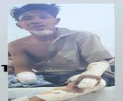 HLYAN PHYO AUNG: He was abducted by Terrorists (Myanmar security forces) in Magway on Mar 27. He was shot in the left hand 3 times, in the right leg 3 times &amp; in the left leg 6 times with rubber bullets. His right hand was amputated as you see in thefrom myanmar model buttock