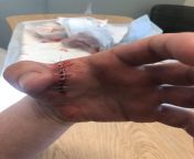 My repaired hand, &#36;0 CDN and done in under two hours at a hospital. from cdn dbxxx