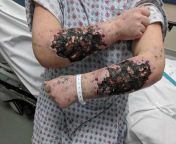 Severe skin necrosis caused by laced heroin in an IV drug user. The drug was laced with a powder called Rizzy, a toxic substance used to color the petals of plants. from heroin in