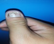 I keep bitting my fingernails I keep bitting my finger nails (my thumb is the worst) and i dont know how to stop can i get some tips? Also i have read online that finger nails might not grow back from bitting it too much is there still hope for my thumb? from vaginal birth if is impossible episiotomy is mustbirthing
