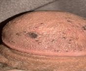 HELP SO TOODAY I GOT SOME TYPE OF PENIS PROCEDURE ON MY PENIS DUE TO SOME GLANS AND SOME DISCOLORATION ON MY PENIS HEAD and now I have some Brown spots on my penis after the procedure from fat pink black penis head