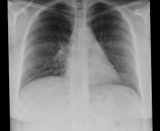 Struggling with costochondritis and breathing at the moment. My first xray showed a shadow so I was then sent for a second one. Any thoughts on it? App with doctor is next week. from susma bhabi with doctor sexmil aunties