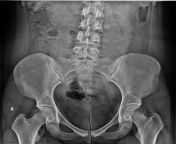 What do this black spot in my pelvis on my X-ray? (Am I pregnant?) from ashorya ray xxxobs press