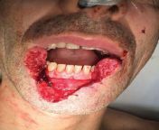 Lip injury due to human biteLower Lip and Chin Reconstruction from sunyleon lip