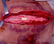 Temporary abdominal closure with zipper-mesh device for management of intra-abdominal sepsis. from abdominal