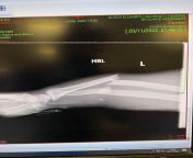 Life is full of surprises! I threw a spinning back fist in my amateur MMA fight and broke my forearm, I have surgery in 1 hour, AMA. from woman man mma