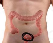 Do i have ibs? from ibs s
