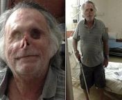 Who remembers this cannibal story? 65-year-old homeless Miami man Ronald Poppo, nearly killed in 2012 after being attacked by a cannibal named Rudy Eugene, he pounced on Ronald and began to bite and eat his face. The police had to shoot the crazed man. Ro from cannibal cupc
