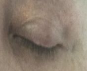 I have white lines on both eyelids. Looks like eyeliner. Ive been on tacrolimus and ivermectin for six weeks, diagnosed rosacea/eczema on face and eyelids. Im told to use tacro on eyelids. Face improving but not eyes. Do mites look like this? from not on face