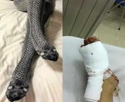 This woman was sleeping in snake printed pajamas and one foot was outside the blanket. Her husband thought it was a snake and he broke her foot. from snake and man