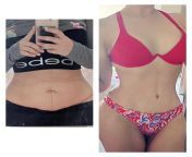 Six months post op and feeling great! TT, Lipo &amp; BBL I am 34. If you are thinking about it, do it! from tt 55 rc