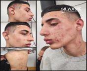 Bruises and other wounds are photographed on the face and body of the Palestinian boy Amir Abbasi (15 years old) after he was brutally beaten by the Israeli occupation soldiers in the old city of Jerusalem. May 7, 2023 from kashmira in city of