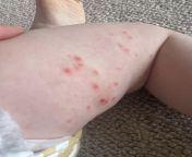 Toddler (18mths) rash/spots from lolibooru toddler