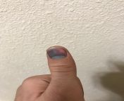 I smashed my thumb in a 90 pound car door. Whats gonna happen to my thumb lmao from thumb