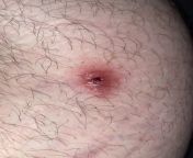 Did I just pop a boil or a big zit? Its located on stomach. Brownish pus and filled with blood. It had 4 white heads in a square but when I squeeze d it it popped under the heads instead from star pus