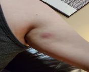 Bump/ lump on arm near armpit - Help! from lump com