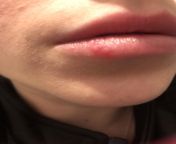 Sudden bumps on lip from kirna rothad face lip fap