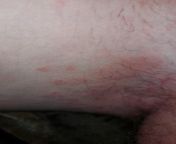 is this jock itch, and can jock itch cause hard lumps underneath, cause the first time I went to the doc she said it s jock itch the second time erythrsma, I&#39;m scared of that hard lump underneath help please! from job jock