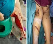 Boar attack on a woman in Singapore. Patient was a month in bed recovering and needed three surgeries on her legs. from silent boar