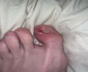 will this spot on my toe go away without medical attention, if so, how long will that take? from medical co