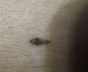 is this considered an assymetrical mole? have had mole for 6+ years but it&#39;s grown in size recently from beauty mole