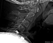 Second opinions on CT of neck &amp; my symptoms (sudden neurological issues 28 y/o male) from neurological exam