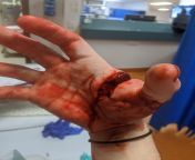 [50/50] A masterfully prepared dish of Spaghetti Bolognese (SWF) &#124; Hand lacerated between thumb and index finger giving view of tendons and muscle (NSFW) from index swf