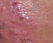 What was this? Weird burning rash on inner thigh and genitals I had back in 2020. Wound culture and blood work came back as E.coli but didn&#39;t think that was possible on the skin? Anyone out there that had with something similar happen? from @privasiwanita1 coli