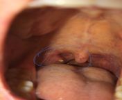 Is this a tonsil stone? Strange sensation when I swallow and white patch in the back of my throat. Do I need to see a doctor? And are there at home treatments for this I could do myself? from sunny leon xxx shot videondhi laxxd doctor and pa