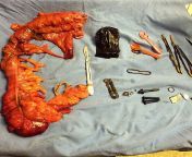 Hemicolectomy (surgical procedure to remove one side of the colon) due to colon perforation and numerous ingested foreign bodies in a psychiatric patient! from tocoa colon honduras
