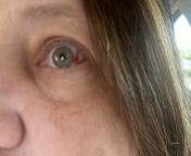 Random occurring broken blood vessel in eye from seal broken blood indian girl