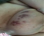 Im assuming this is Hidradenitis. the doctors never help. they prescribe me the same tube or cream each time and call it a day. im young and single and they make me feel so disgusting. i hate having sex now. from bangla chaitali doctors sex videoctress shriya sex vxxx