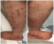 32, Male, 62, 360lbs, Hispanic. Person has been getting blisters on the feet and cornerbacks of hands. Very dry areas around the bottom of the feet. Skin tightness around the skin of the leg, especially that area where probably a bug bit them a year ago. from doctor feet veiny