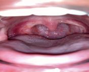 Hello. Is this oral hpv? Im a young adult that been vaccinated against hpv since I was pre-teen now. I dont got any genital warts on my private parts. Im just worried about this hpv in the back of my throat. from young boy fucking pre teen