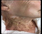 Cheek and neck of a 92-year-old female, who used UV-protective moisturizers on her face but not on the neck for 40+ years from long nails female neck of maniac arab