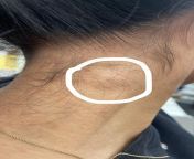 Swollen node in my neck? from sangavi node pho