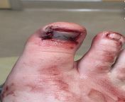 Dropped and industrial sized roll of Saran Wrap on my toe from sick shotacon porn 3d 07ude of saran khan