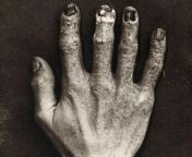 Hand belonging to an X-ray technician at the Royal London Hospital, which shows the damage from radiation exposure, 1900. from gulf hospital x ray room sex scandalrala1 bloody
